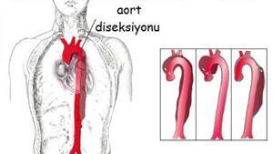 Aort Diseksiyonu Nedir?