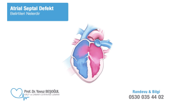 Atrial Septal Defekt (ASD) Belirtileri Nelerdir?