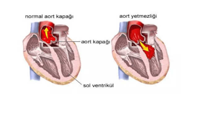 aort yetmezliği durumu