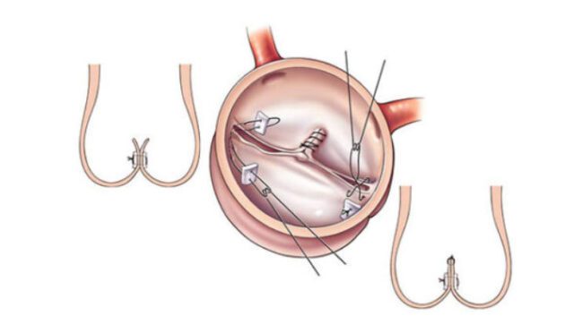 Biküspit Aort Kapak Ameliyatı