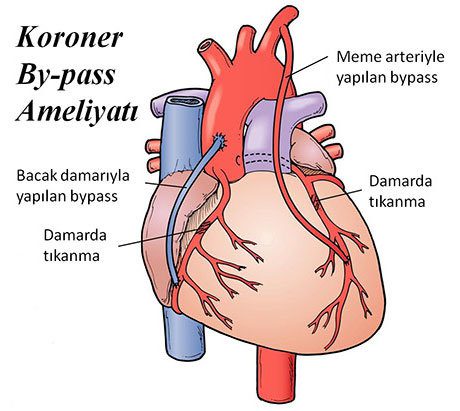 Unter welchen Umständen wird eine Koronarbypass-Operation durchgeführt?