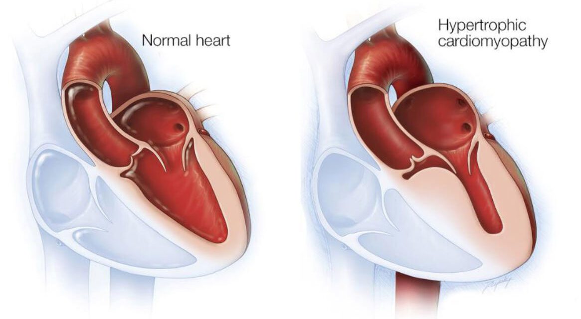 Hypertrophic Cardiomyopathy