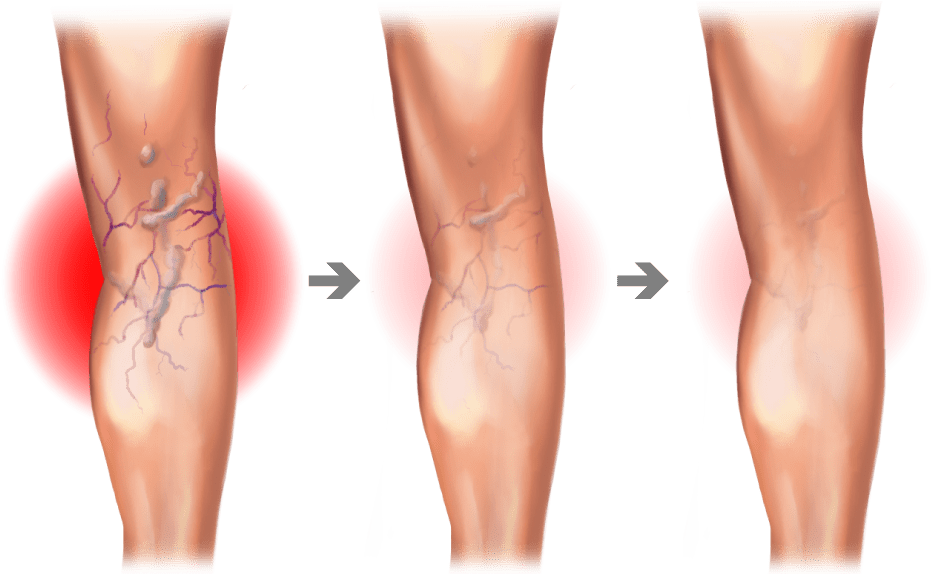 Causes of Varicose Veins