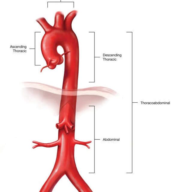 What is Aortic Coarctation?