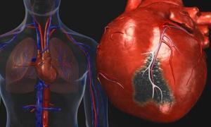Arteriopatía coronaria