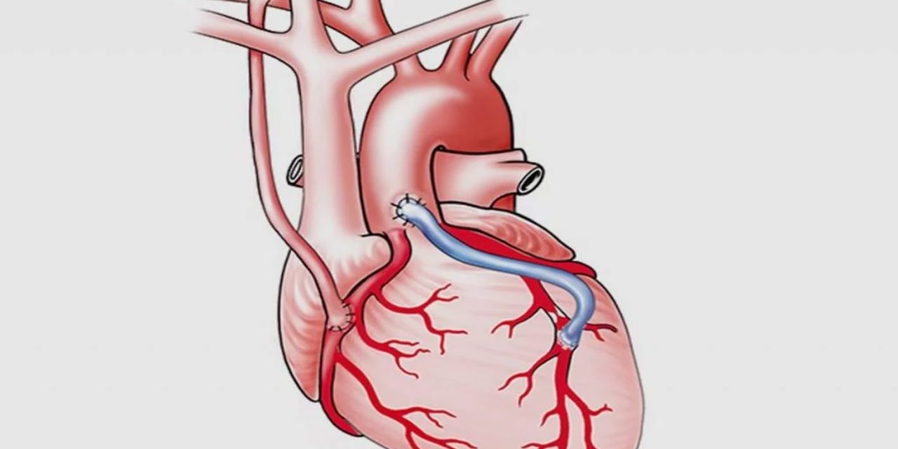 Was ist eine Koronarbypass-Operation?