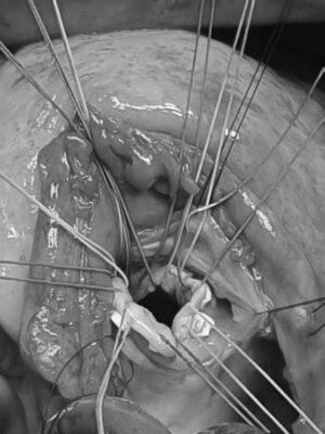 Koltukaltı-sağ atriyumdan vsd kapama