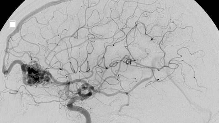 AVM Hastaligi Arteriovenoz Malformasyon