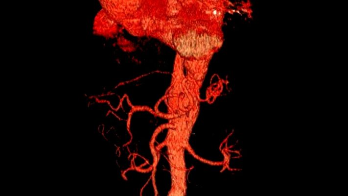 Aort Damari Nedir Aort Damari Yirtilmasi Neden Olur