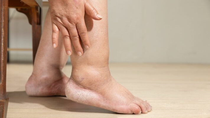 Ayak Sismesi Neden Olur Ayak Sismesine Ne Iyi Gelir