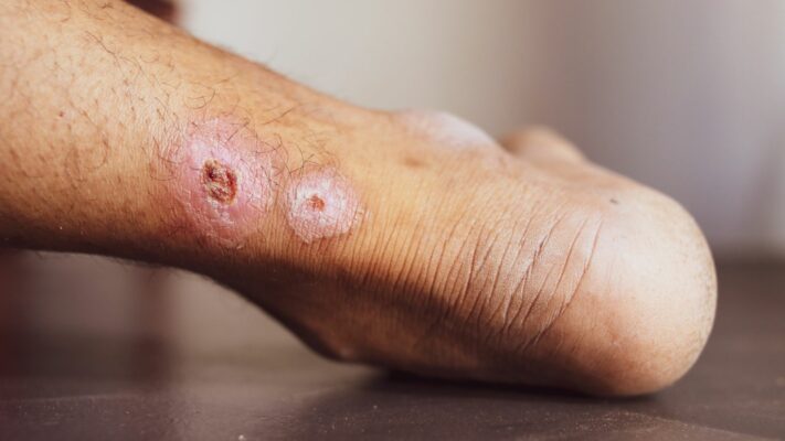 Bacak Ulseri Nedir Tedavileri Nedenleri ve Turleri