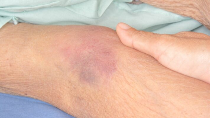 Bacaklarda Morluklar Hangi Hastaligin Belirtisidir