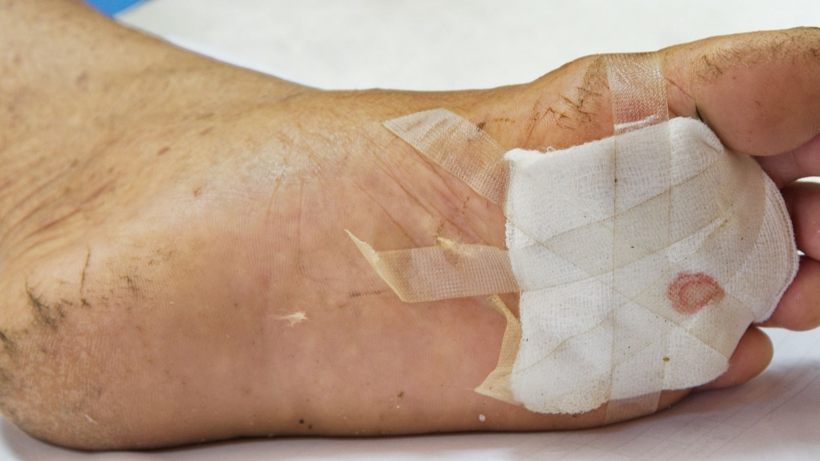 Iyilesmeyen Ayak Yaralari