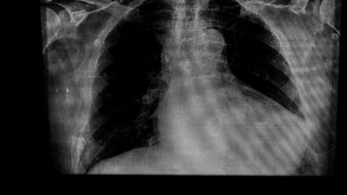 Kalp Buyumesi Nedir Kalp Buyumesi Nedenleri ve Belirtileri