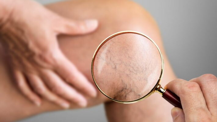 Kilcal Varis Tedavisi