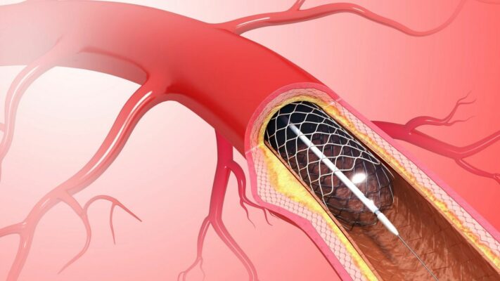 Stent Nedir Neden ve Nasil Takilir