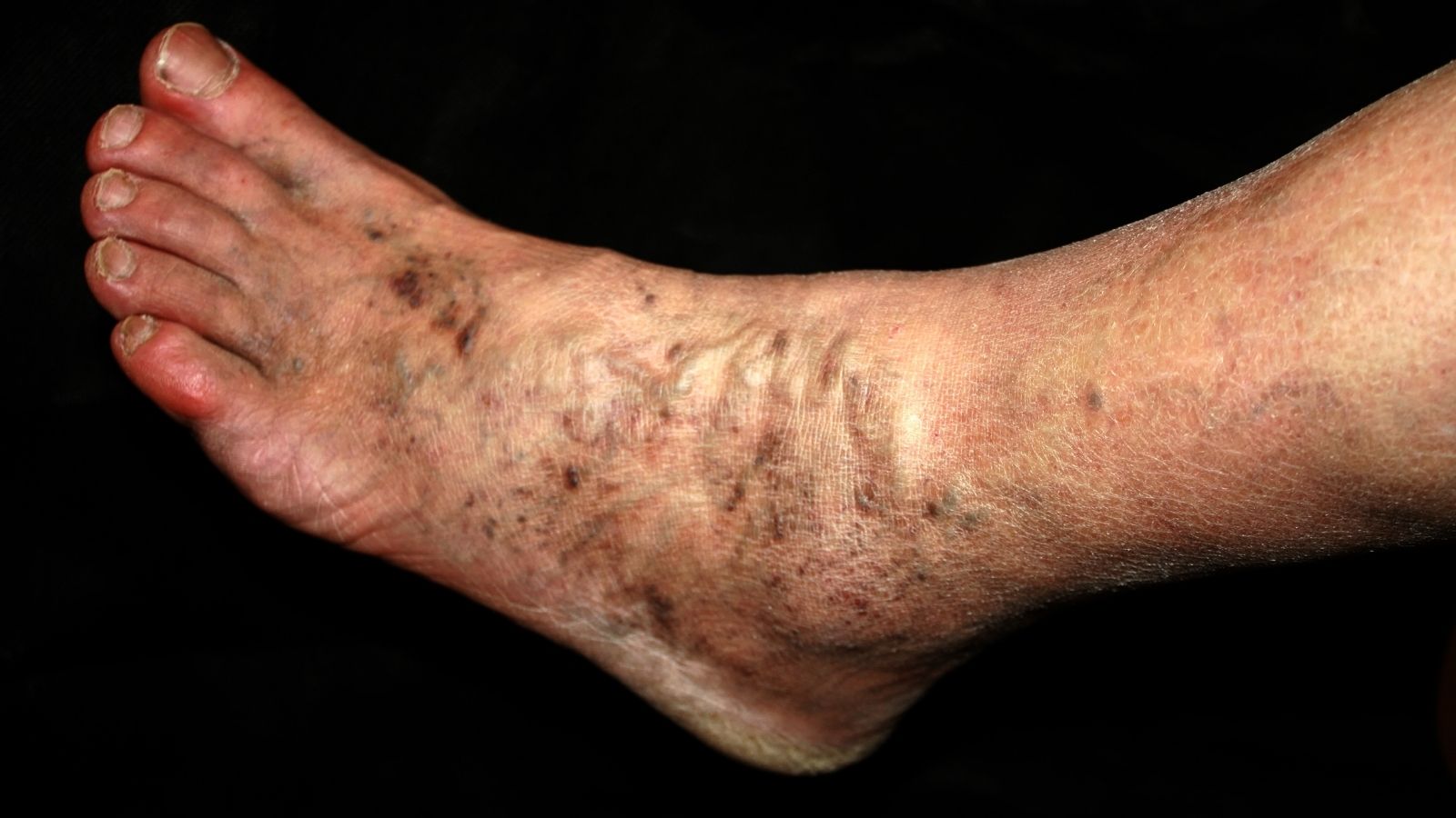 Tromboflebit Nedir Nedenleri Belirtileri ve Tedavisi