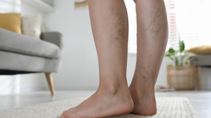 Varis Belirtileri Nelerdir Varis Baslangici Nasil Anlasilir