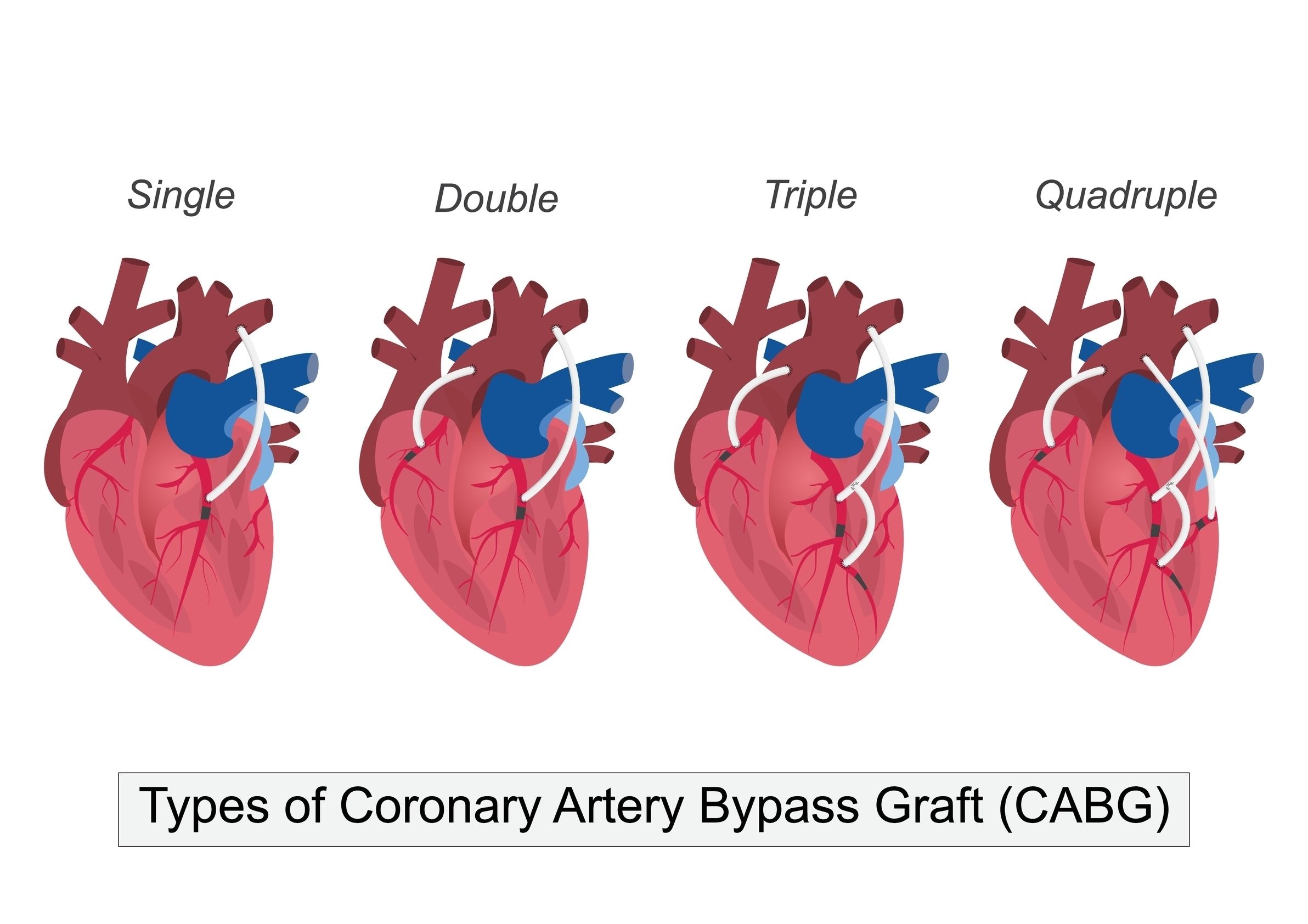 1,2,3 ve 4 damar bypass ameliyatı illüstrasyonu