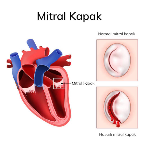 Mitral kapak tamiri ve degisimi