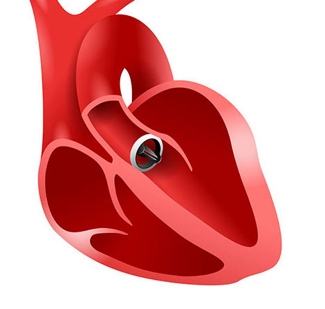 aort kapak cerrahisi