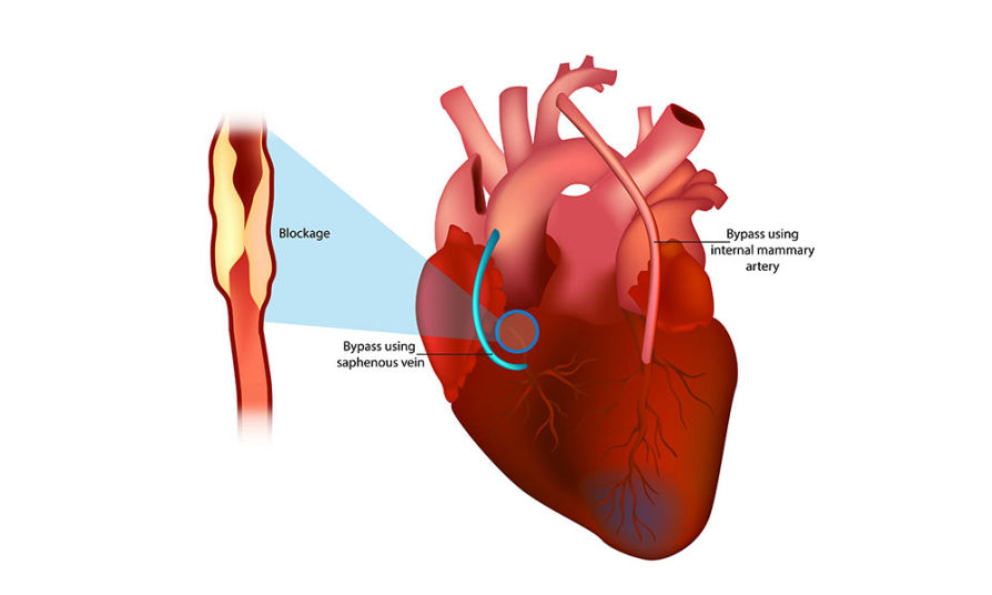 minimal invaziv bypass ameliyati