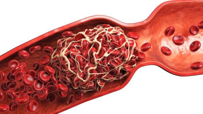 Mezenterik Arter Baypas Ameliyati