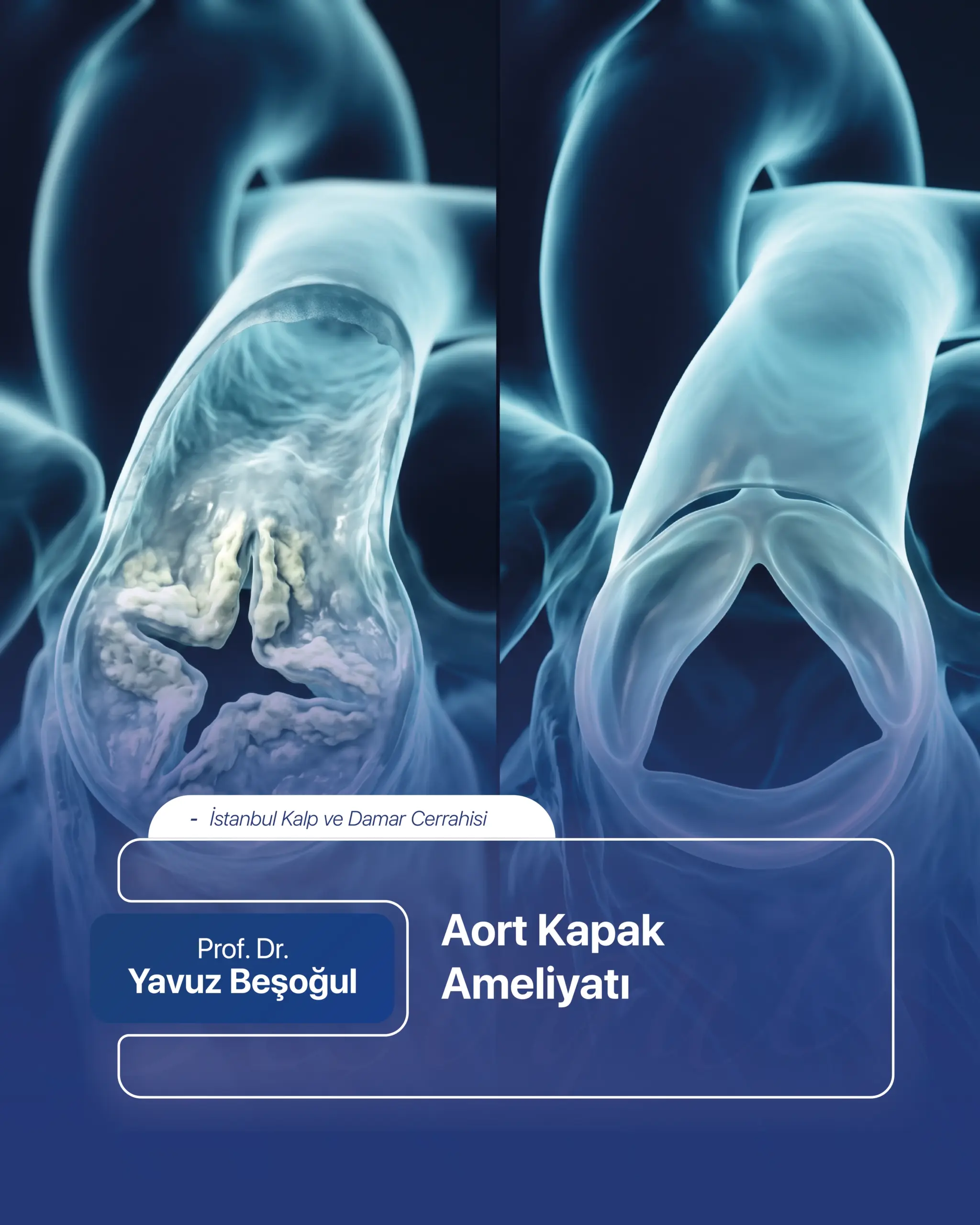Aort Kapak Ameliyatı